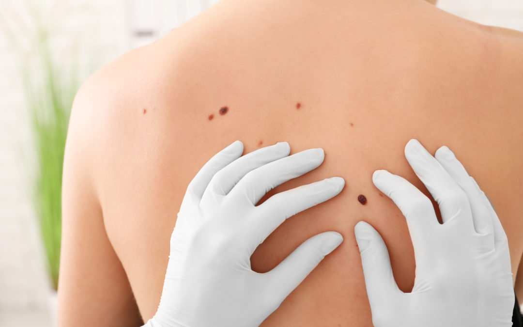 Identifying Symptoms of Skin Cancer